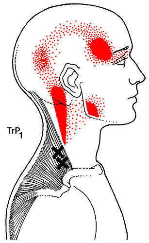 trp1